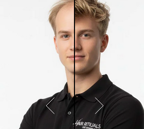 Hair system Before and After